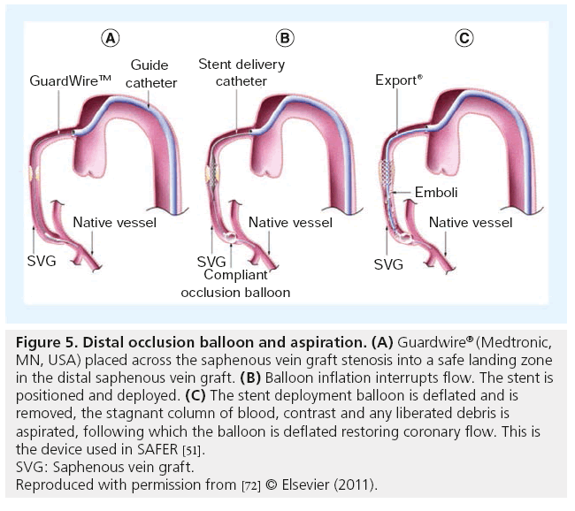 interventional-cardiology-distal-occlusion