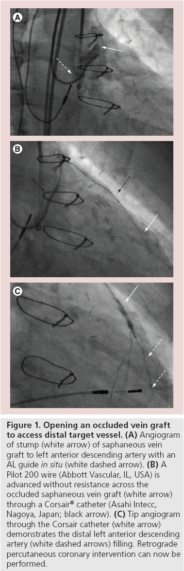 interventional-cardiology-distal-target-vessel