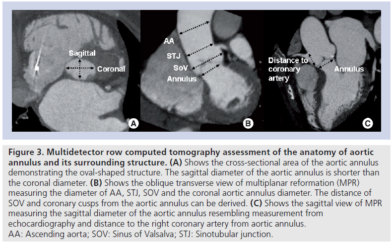 interventional-cardiology-distance