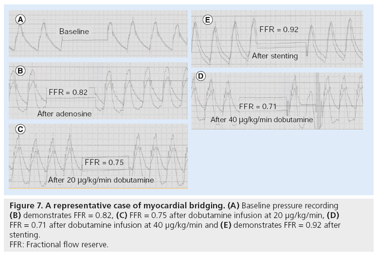 interventional-cardiology-dobutamine-infusion