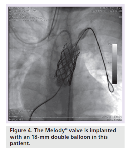 interventional-cardiology-double-balloon