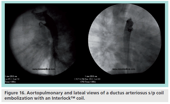 interventional-cardiology-ductus-arteriosus