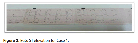 interventional-cardiology-elevation