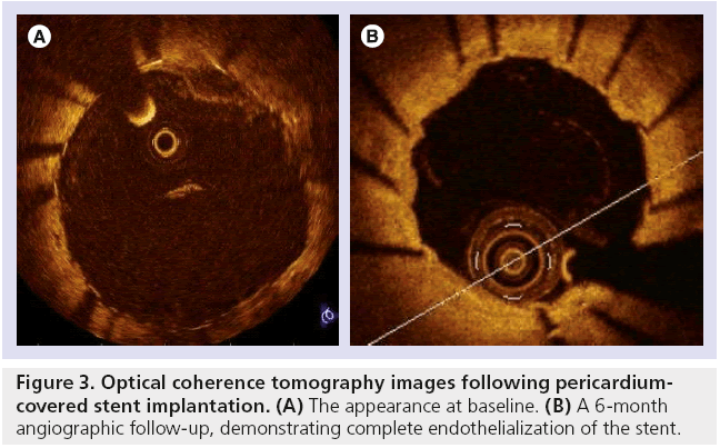 interventional-cardiology-endothelialization-stent