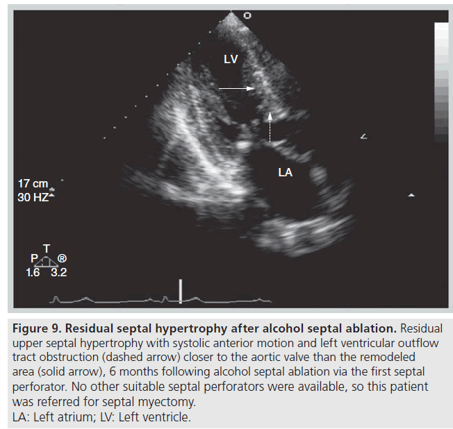 interventional-cardiology-ethanol