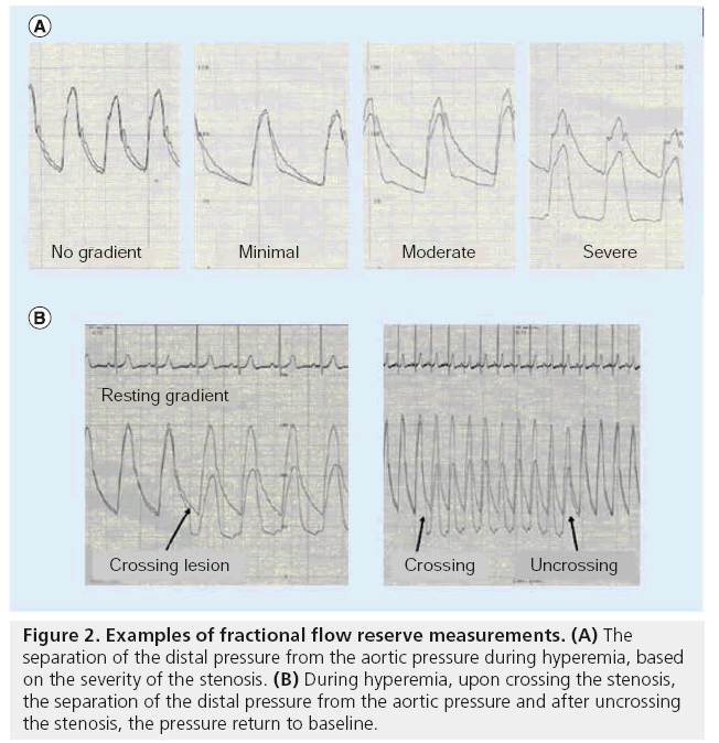 interventional-cardiology-examples-fractional