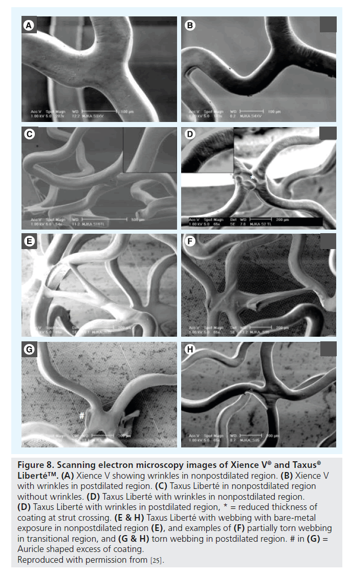 interventional-cardiology-excess-coating