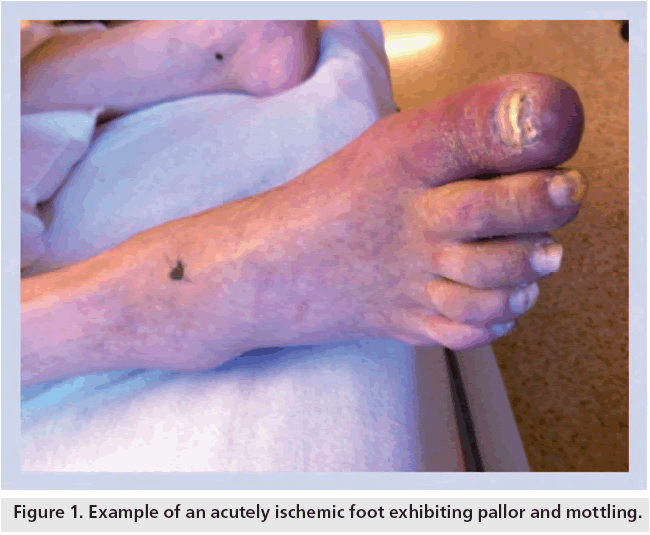 interventional-cardiology-exhibiting-pallor-mottling