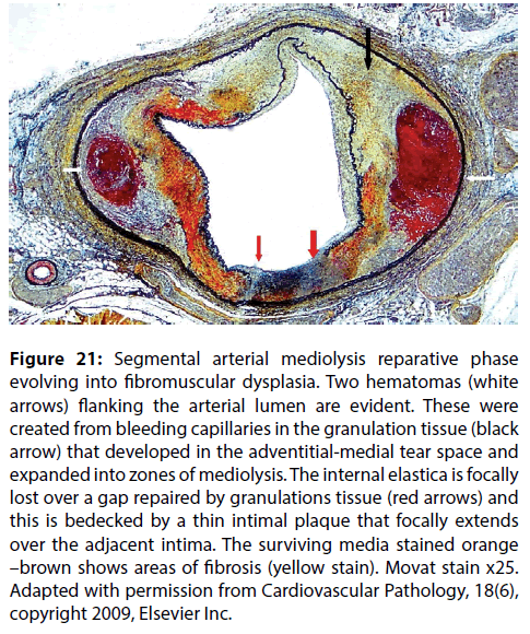 interventional-cardiology-fibromuscular-dysplasia