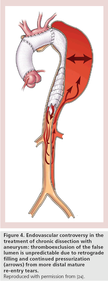 interventional-cardiology-filling-continued-pressurization