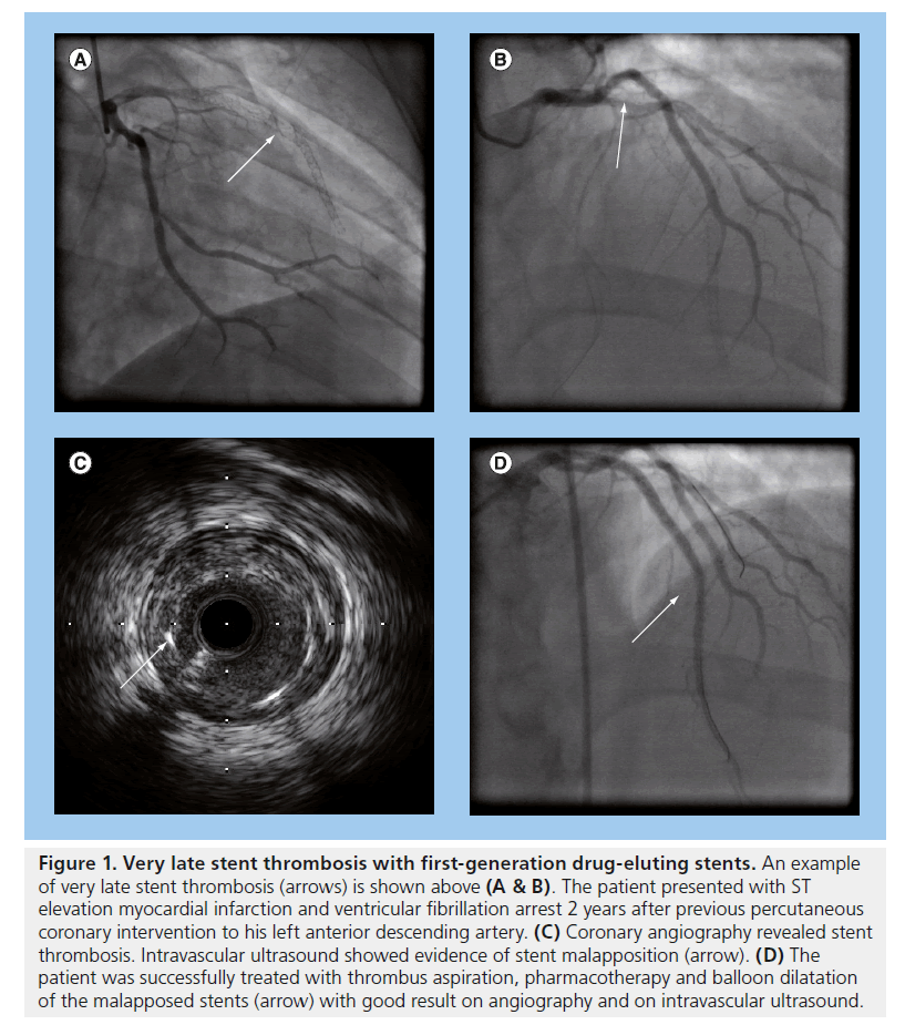 interventional-cardiology-first-generation