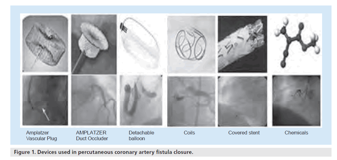 interventional-cardiology-fistula-closure