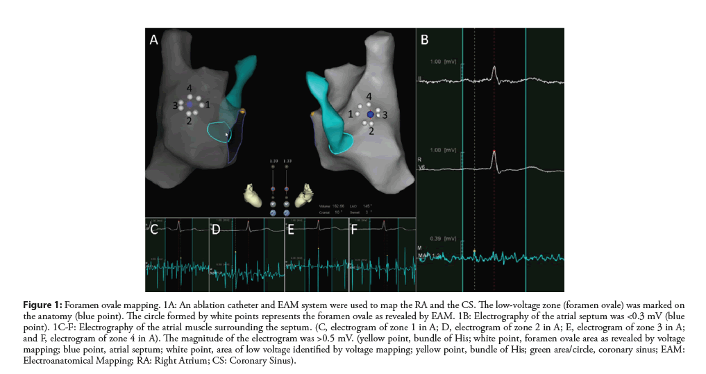 interventional-cardiology-foramen
