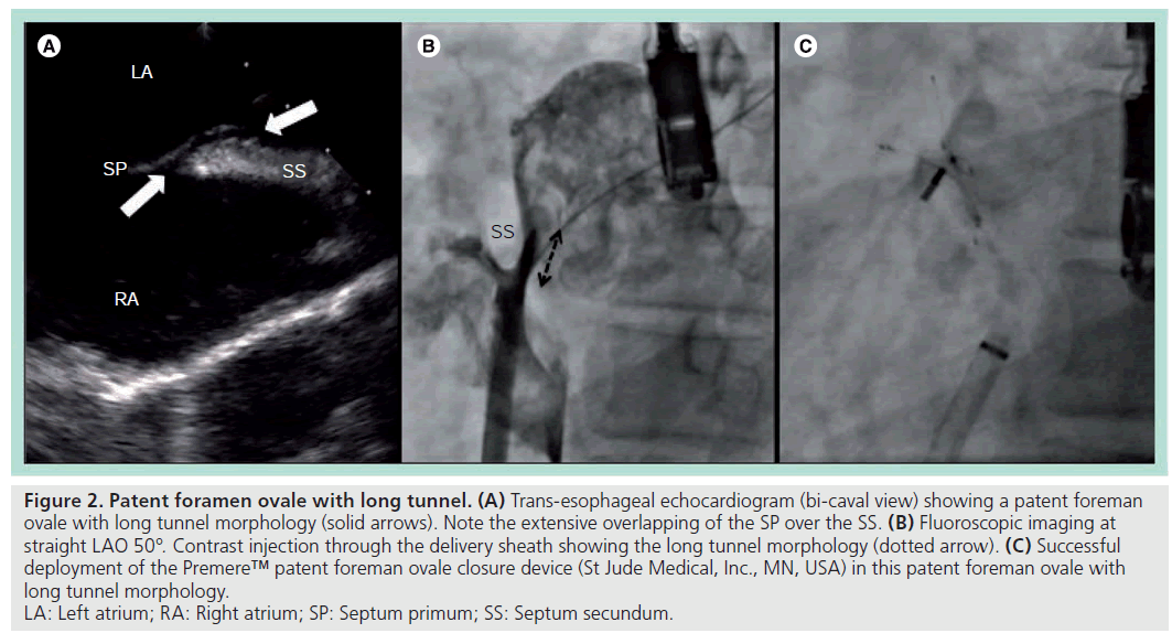 interventional-cardiology-foramen-ovale