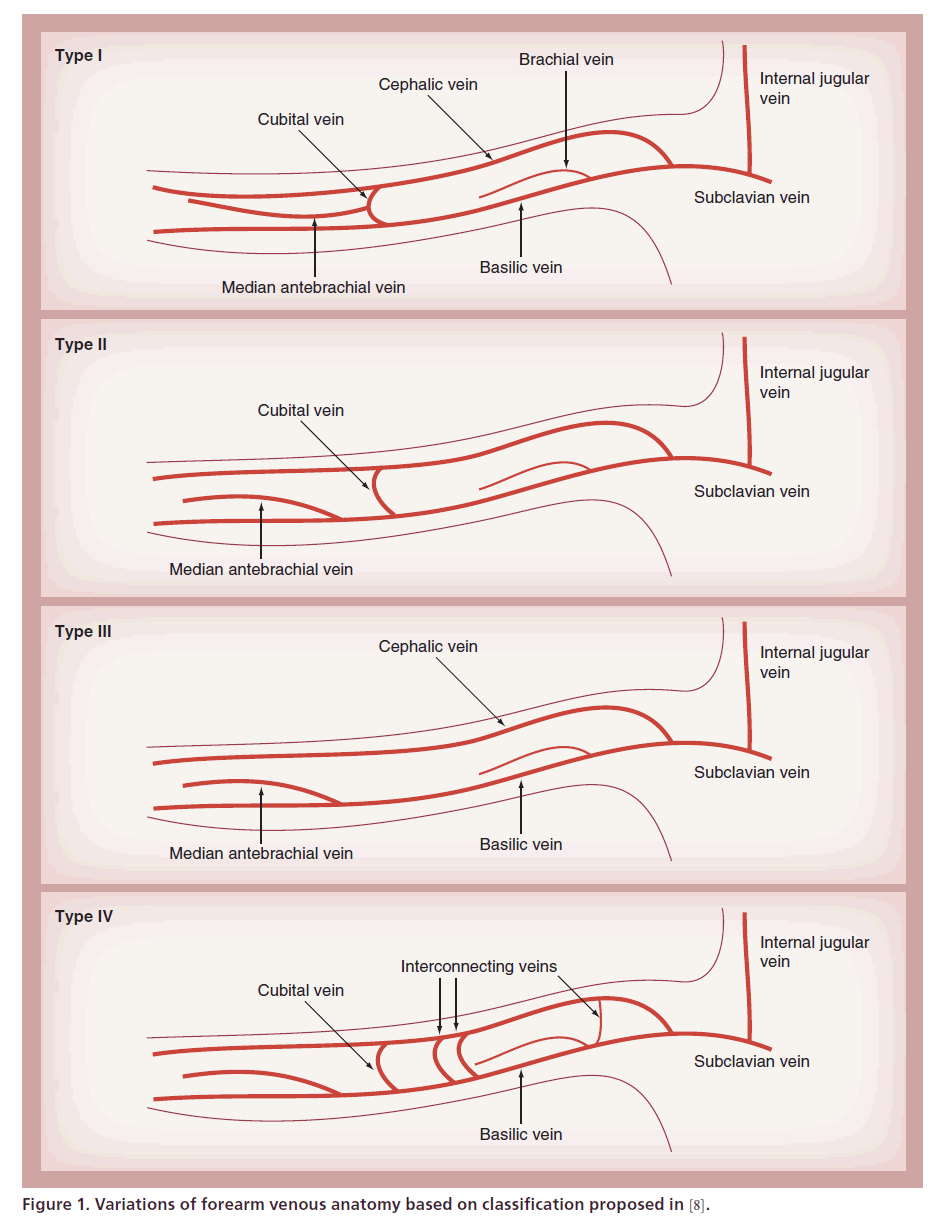 interventional-cardiology-forearm-venous