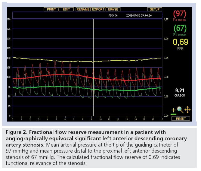 interventional-cardiology-fractional-flow