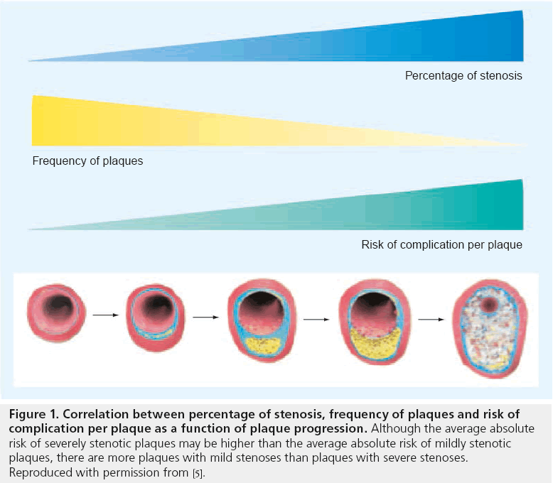 interventional-cardiology-function-plaque-progression