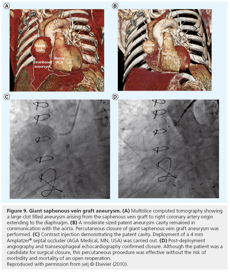 interventional-cardiology-giant-saphenous