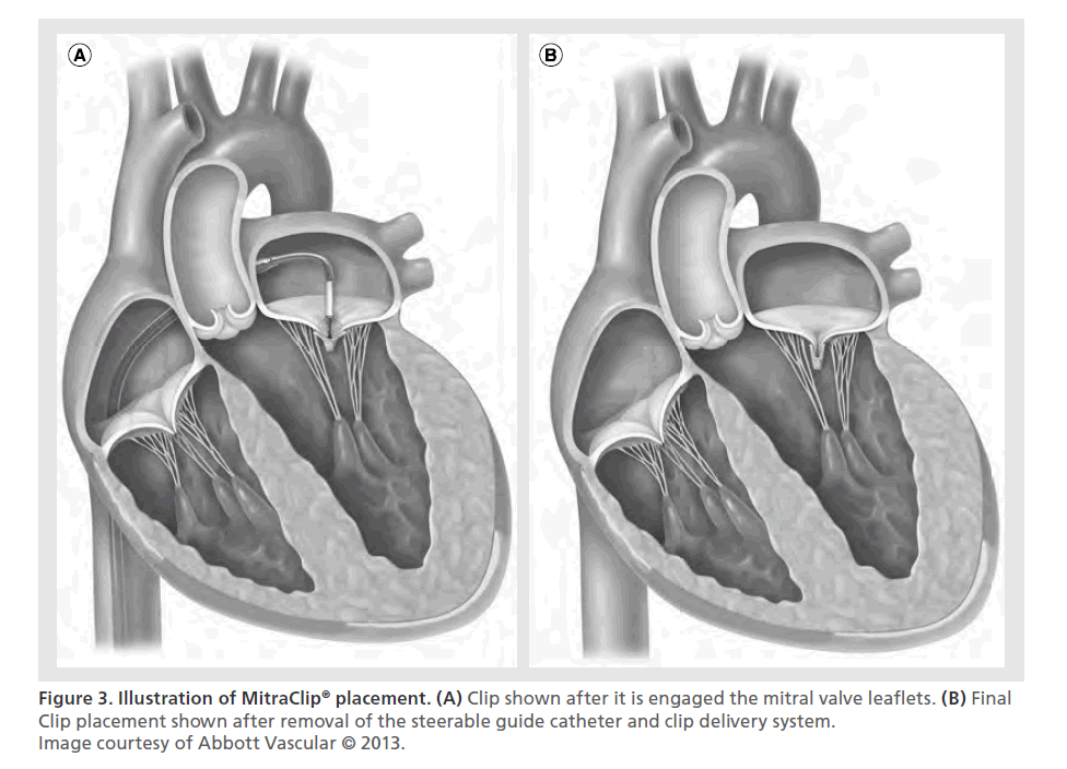 interventional-cardiology-guide-catheter