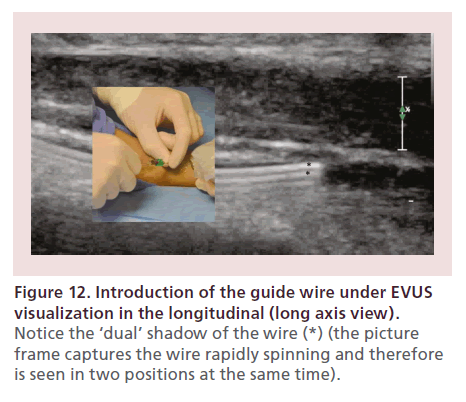 interventional-cardiology-guide-wire