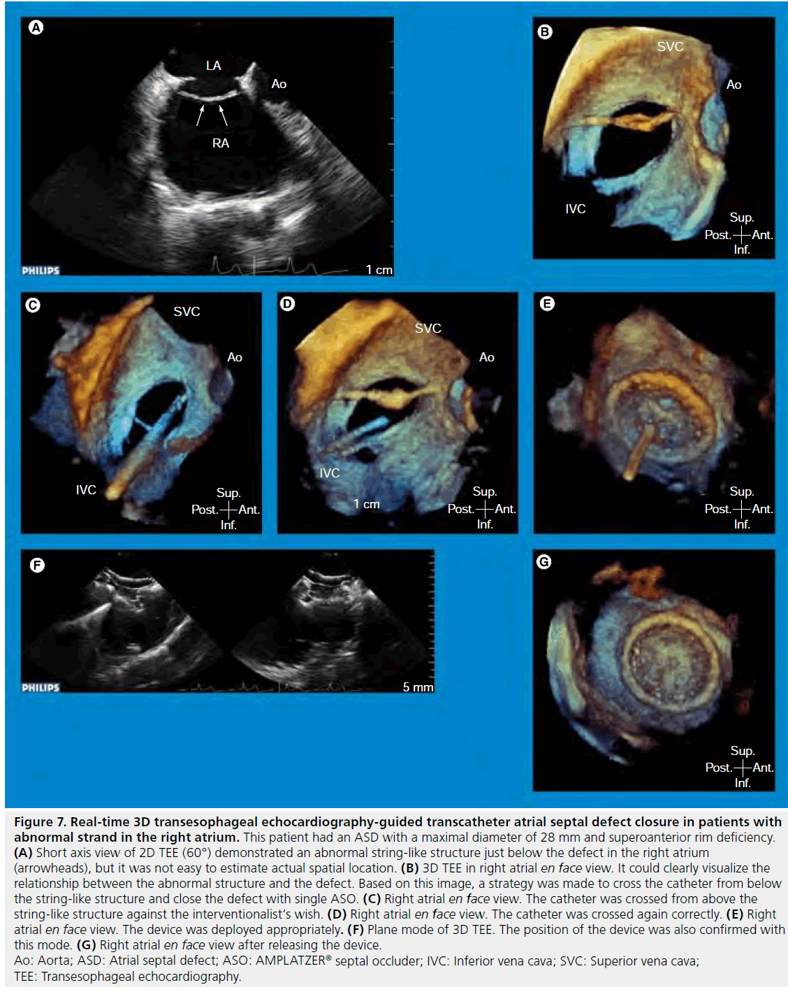 interventional-cardiology-guided