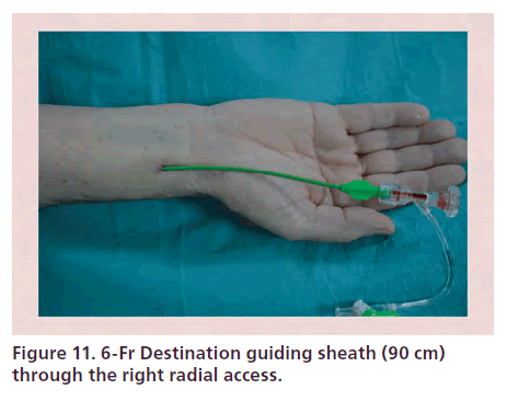 interventional-cardiology-guiding-sheath