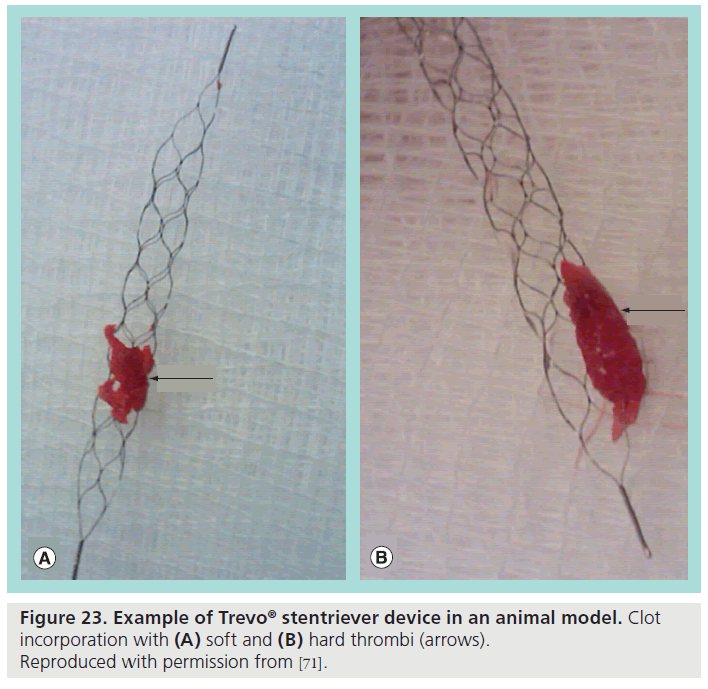 interventional-cardiology-hard-thrombi