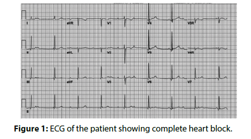 interventional-cardiology-heart-block