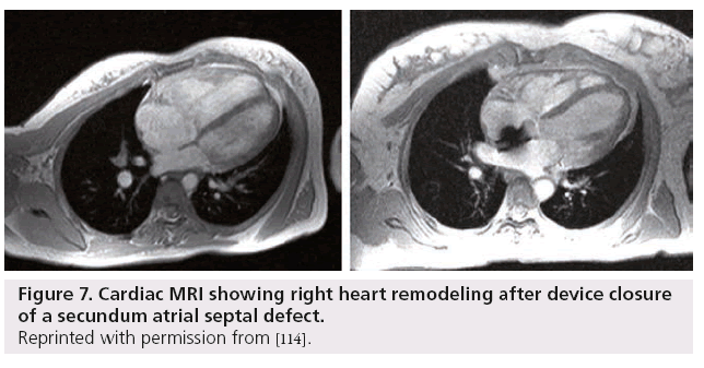 interventional-cardiology-heart-remodeling