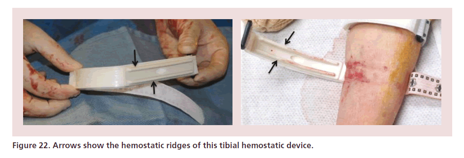 interventional-cardiology-hemostatic-ridges