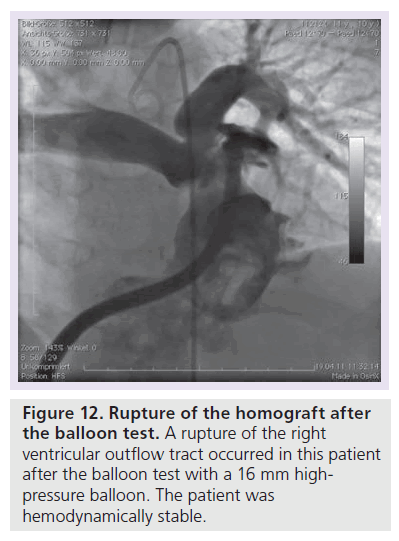 interventional-cardiology-homograft