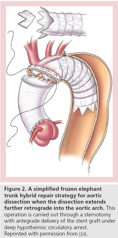 interventional-cardiology-hypothermic-circulatory-arrest