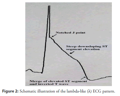 interventional-cardiology-illustration