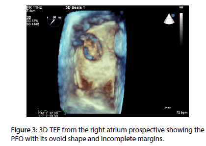 interventional-cardiology-incomplete-margins