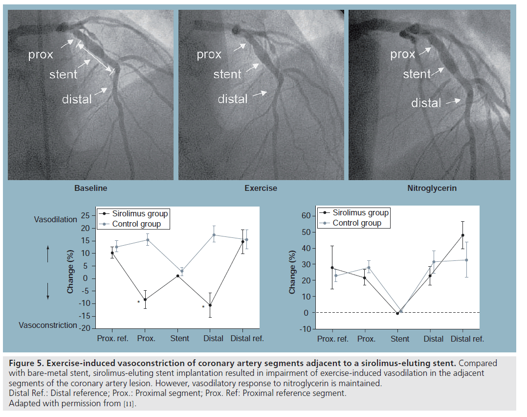 interventional-cardiology-induced-vasoconstriction