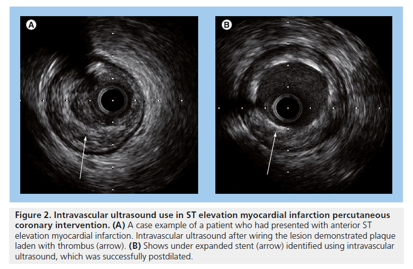 interventional-cardiology-infarction-percutaneous