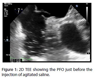 interventional-cardiology-injection-agitated