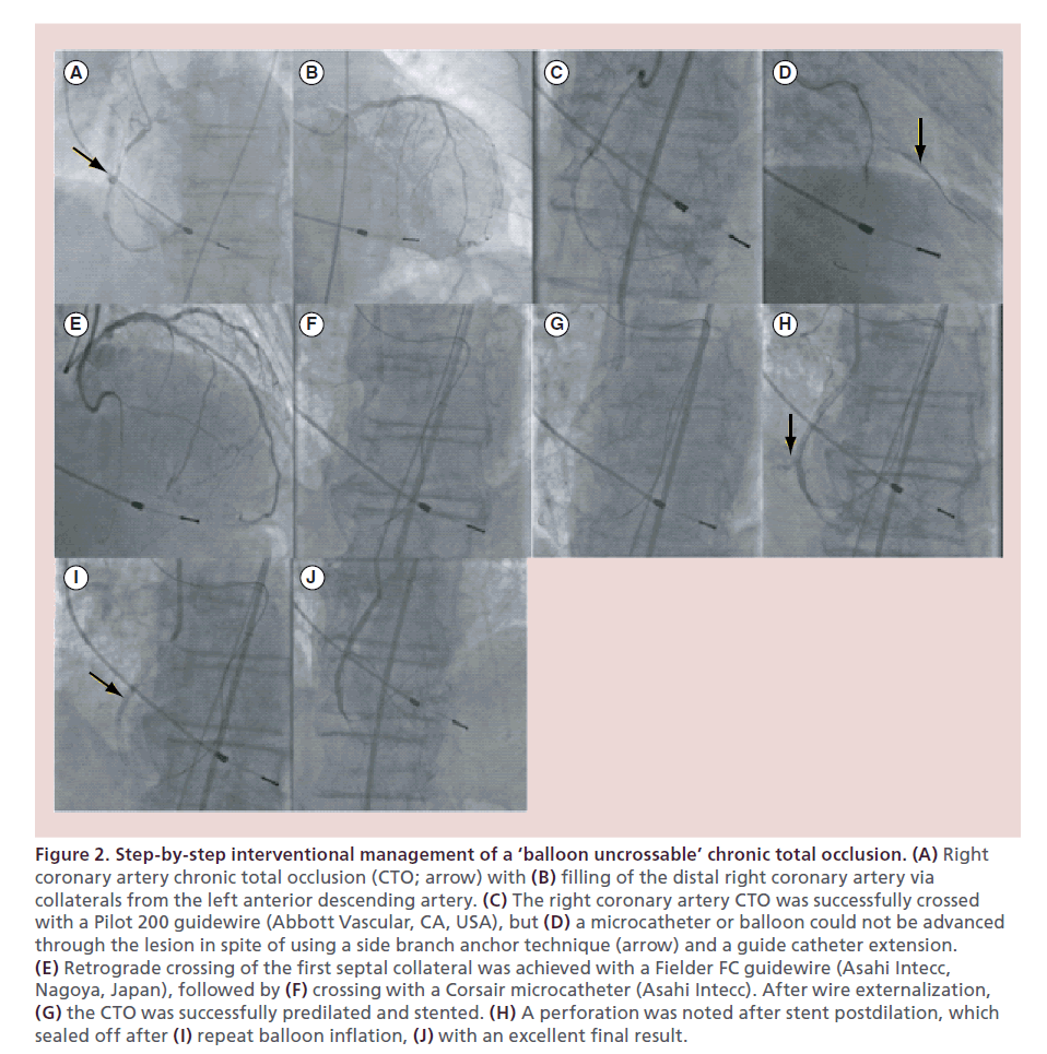 interventional-cardiology-interventional-management