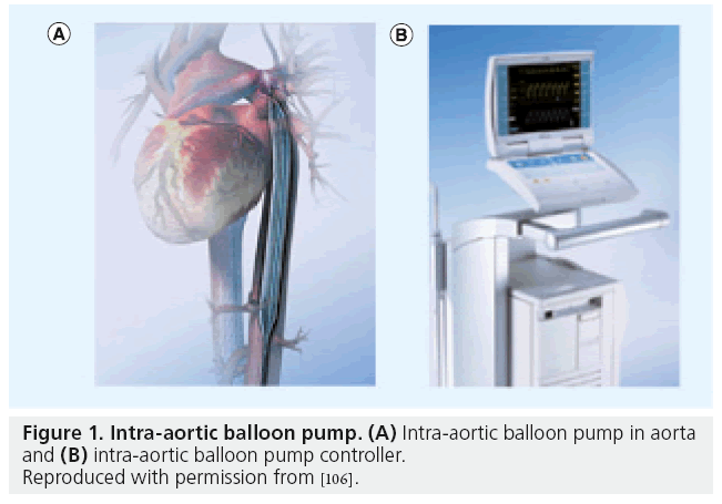 Iabp In Cardiogenic Shock Iabp In Cardiogenic Shock