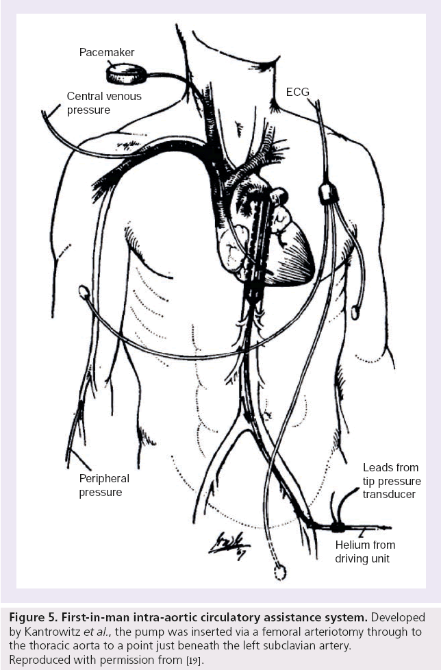 interventional-cardiology-intra-aortic-circulatory