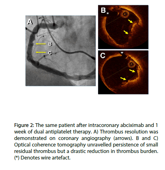 interventional-cardiology-intracoronary-abciximab
