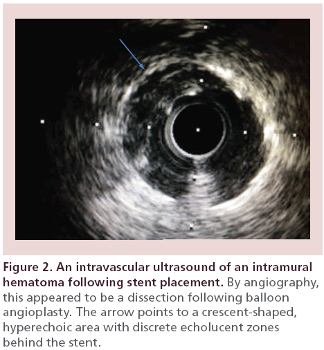 interventional-cardiology-intravascular-ultrasound-intramural