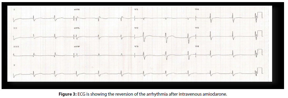 interventional-cardiology-intravenous-amiodarone