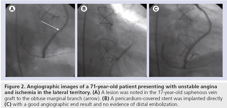 interventional-cardiology-ischemia-lateral-territory