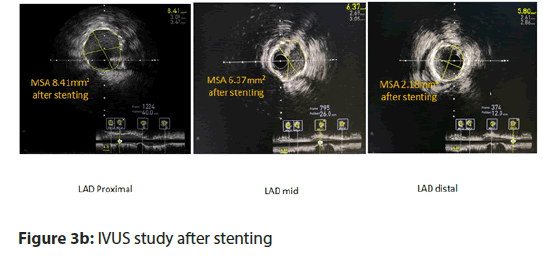 interventional-cardiology-ivus