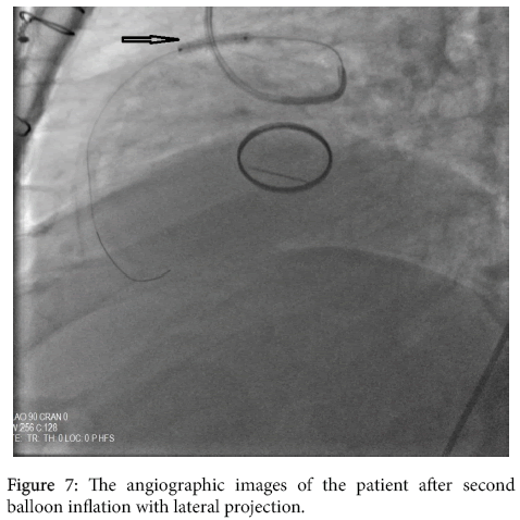 interventional-cardiology-lateral-projection