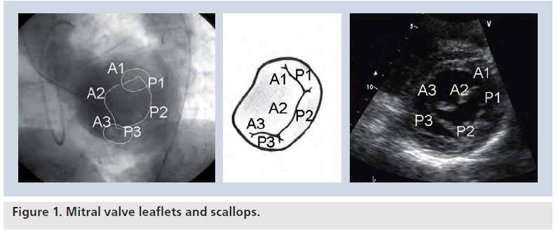 interventional-cardiology-leaflets