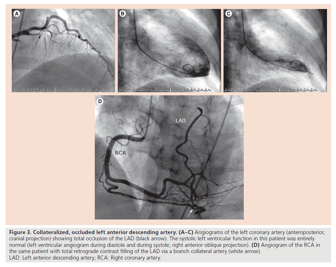 interventional-cardiology-left-anterior