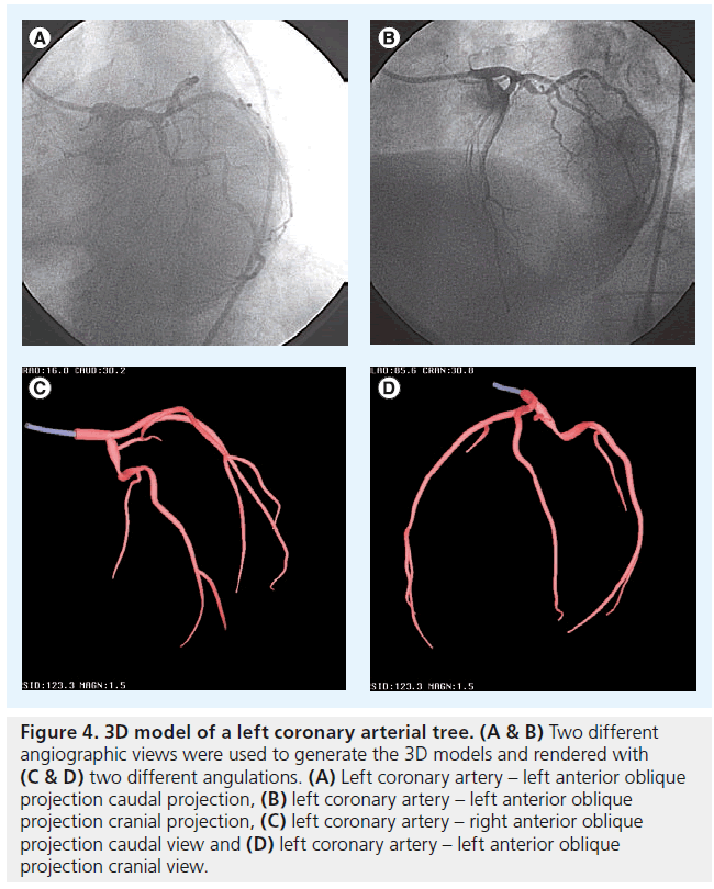 interventional-cardiology-left-anterior