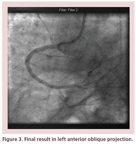 interventional-cardiology-left-anterior-oblique